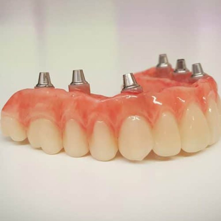 All,On,Six,Pmma,Dental,Implant,Denture